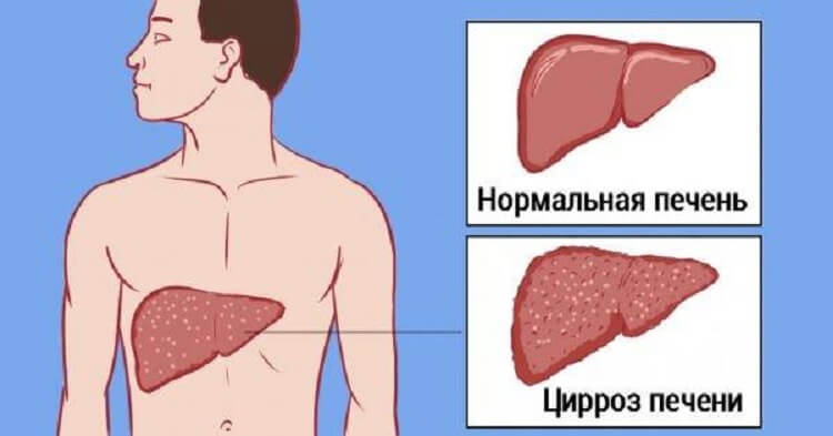 Мы травим каждый день свою печень одним привычным продуктом! Настоящая гадость