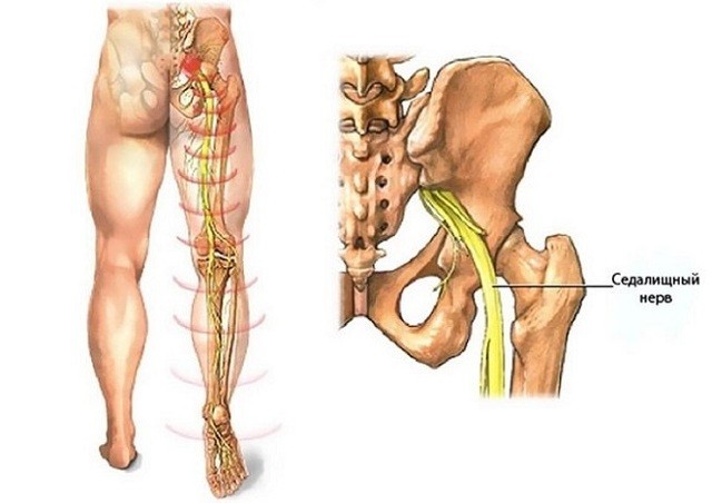 Простой дешевый способ, который эффективно вылечит воспаление седалищного нерва навсегда!