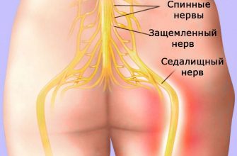 Как снять острую боль при защемлении нервов: 11 работающих способов