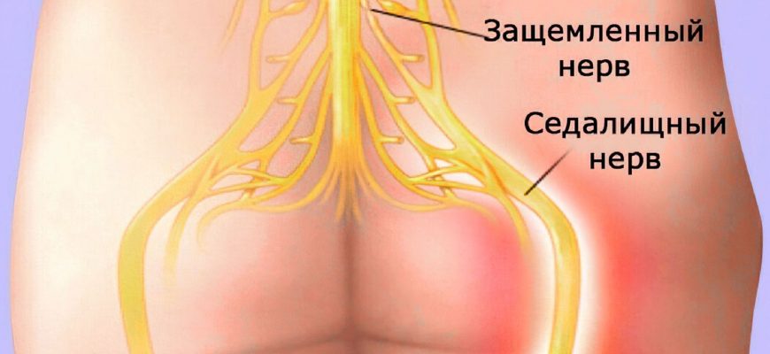 Как снять острую боль при защемлении нервов: 11 работающих способов