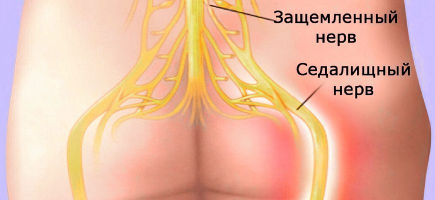 Так вот чем снять боль при защемлении нервов!